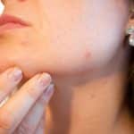 Woman with spots - hypnotherapy training for healthcare professionals